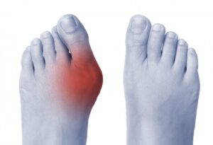 What Causes Bunions and How Can You Treat It the Genuine Way?